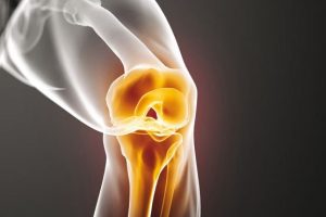 آرتروز زانو